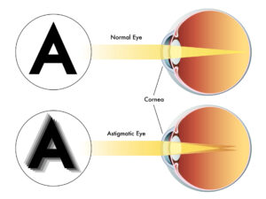 astigmatism illustration