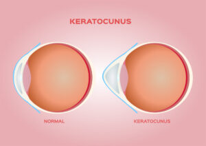 keratoconus illustration