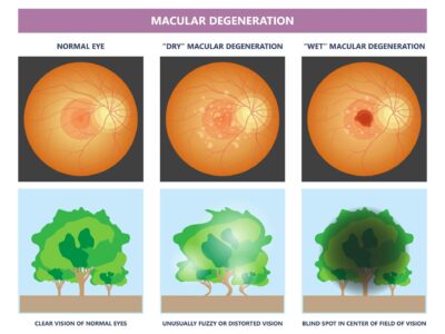 macular degeneration hemorrhage dry wet Age hole pucker edema eye vision loss AMD retina drusen blind spots Blood vessels leak blurry adult lose visual field exam treat contact lens myopia older tear