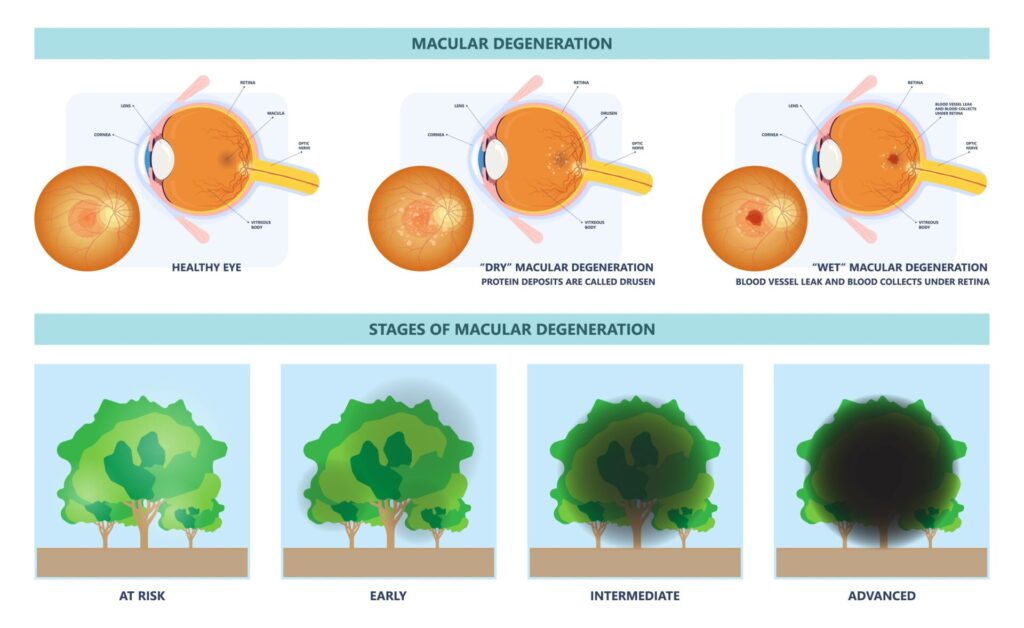 macular degeneration hemorrhage dry wet Age hole pucker edema eye vision loss AMD retina drusen blind spots Blood vessels leak blurry adult lose visual field exam treat contact lens myopia older tear