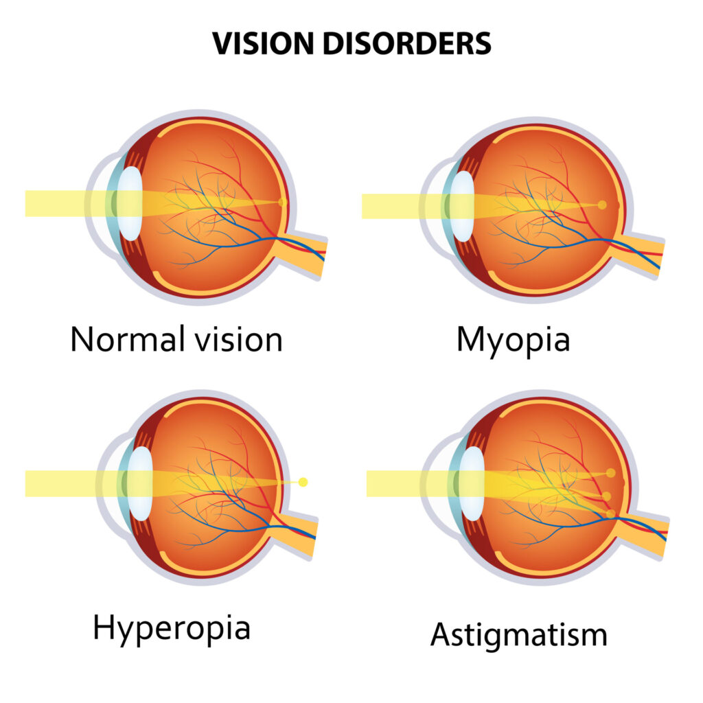 Common vision disorders. Astigmatism, Myopia and Hyperopia