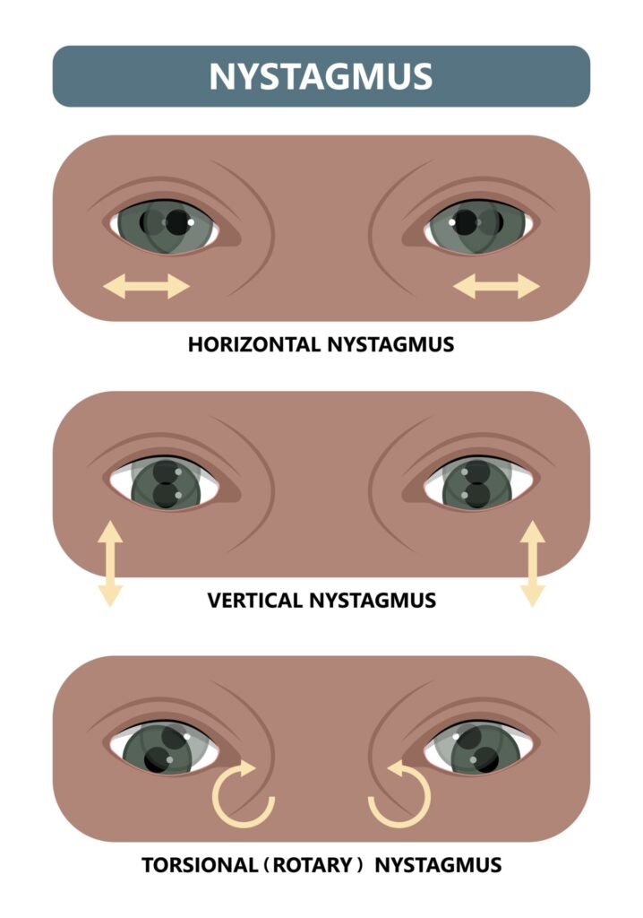 What Is Nystagmus A Deep Dive Into This Dancing Eye Condition