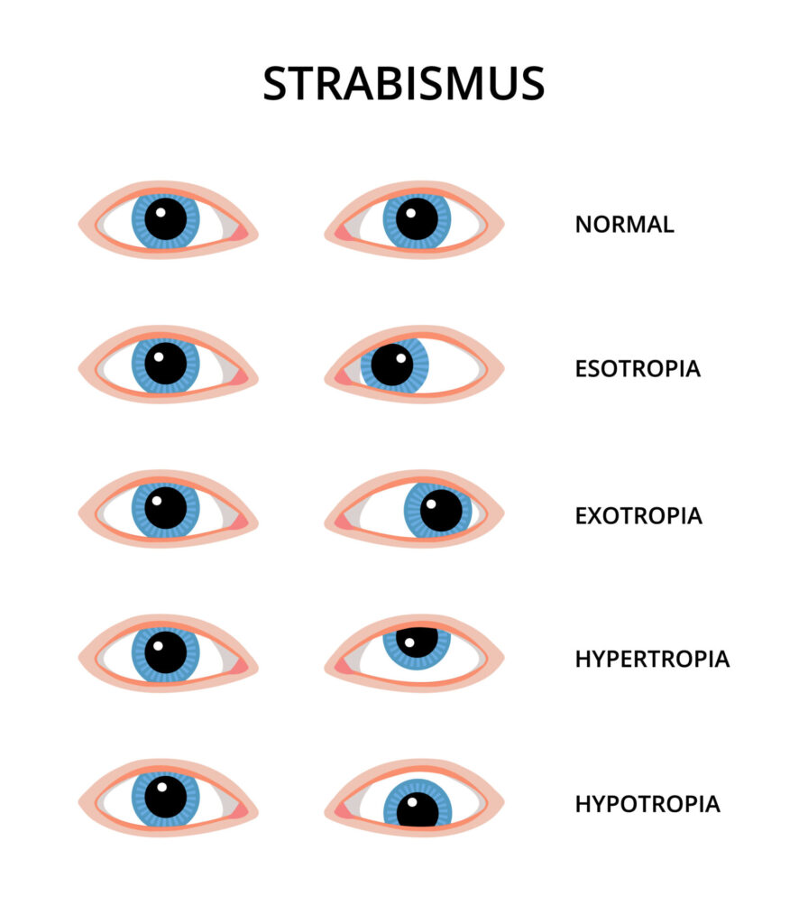 Types of strabismus. Eyes with esotropia, exotropia, hypertropia and hypotropia. Eyesight, eye examination, ophthalmology