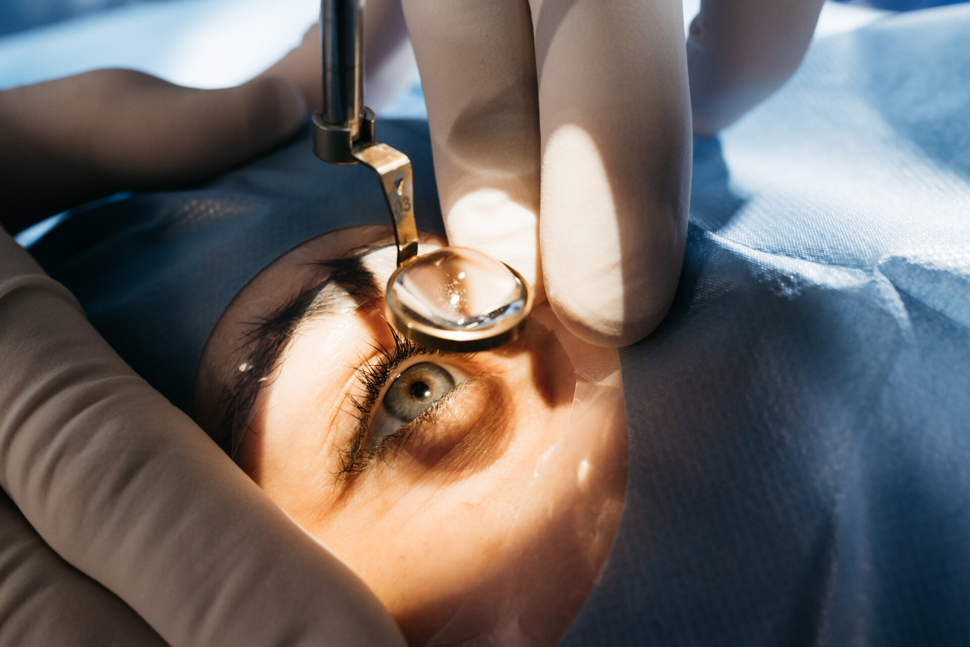 Patient undergoing vision correction surgery performed by an ophthalmologist